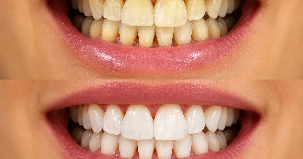 How Long Does Teeth Whitening Last?