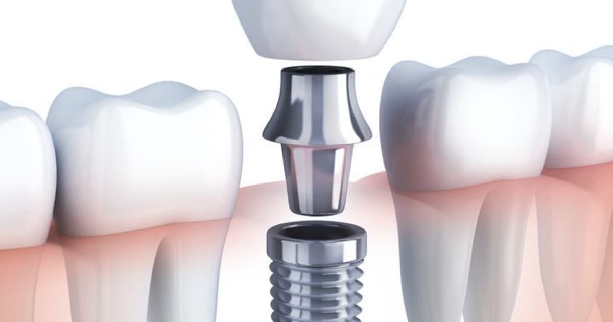 How Many Visits Does a Dental Implant Take?