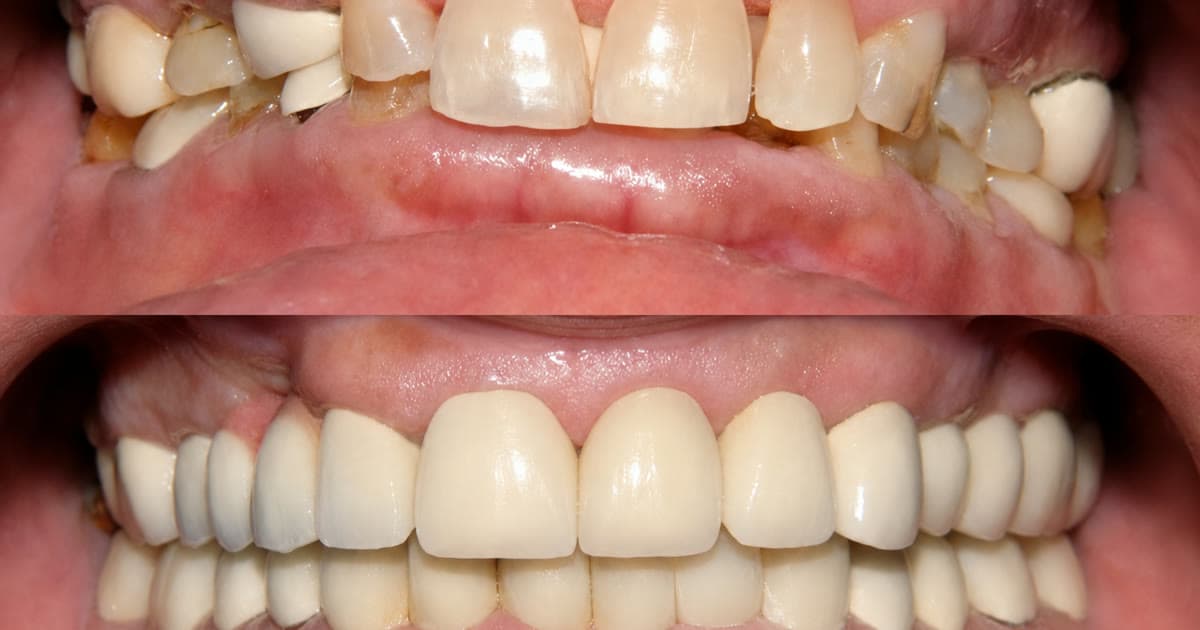 Fixed Teeth in Days: How It Works