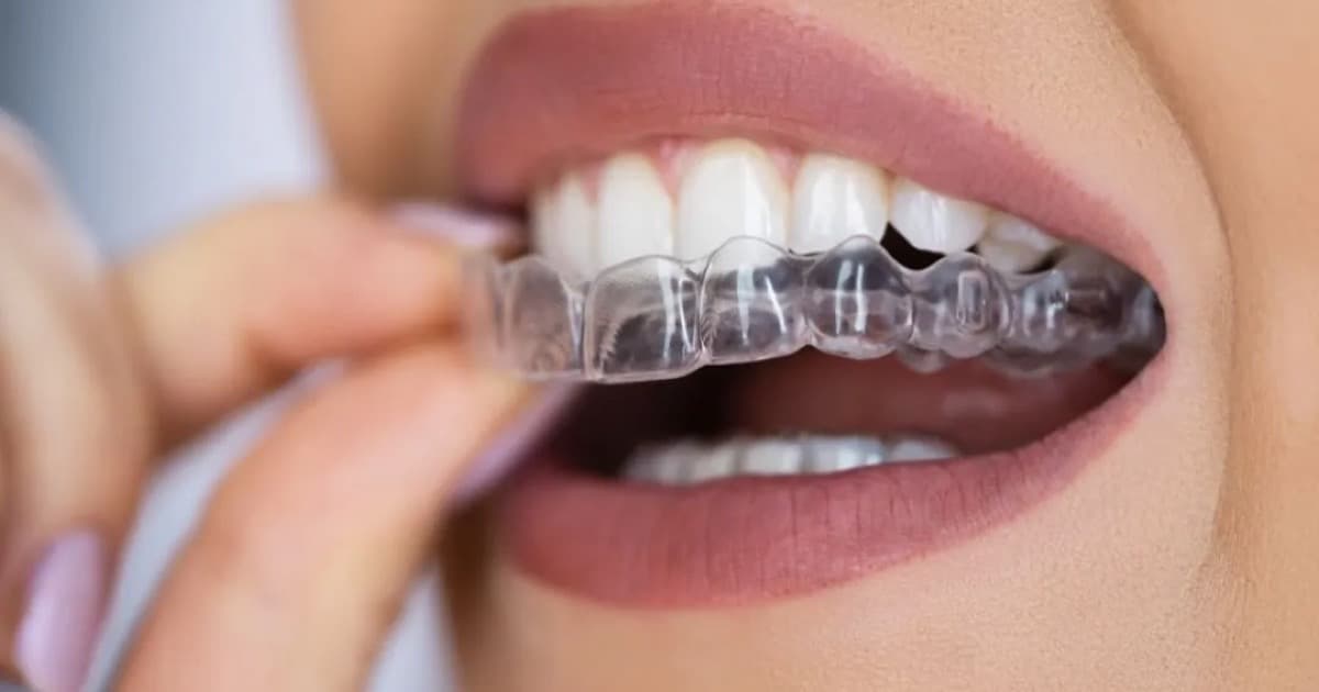Invisible Aligners vs Braces: Which Is Right?