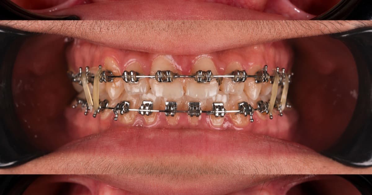 Retainers After Braces: Why They Matter