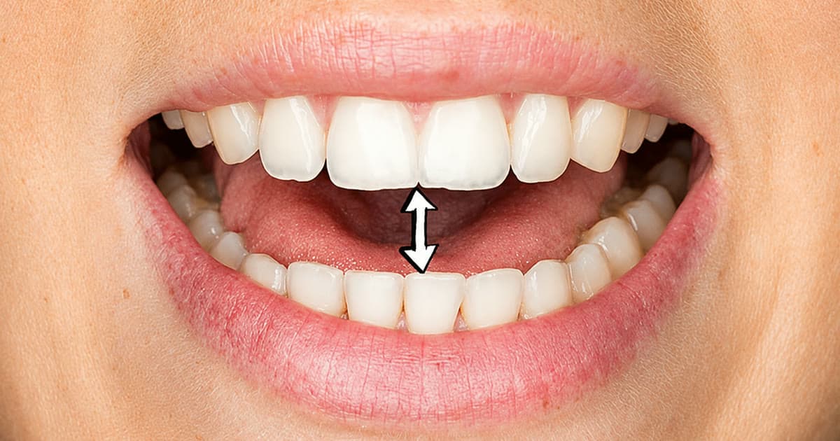 Teeth Grinding: Signs, Damage and Treatment