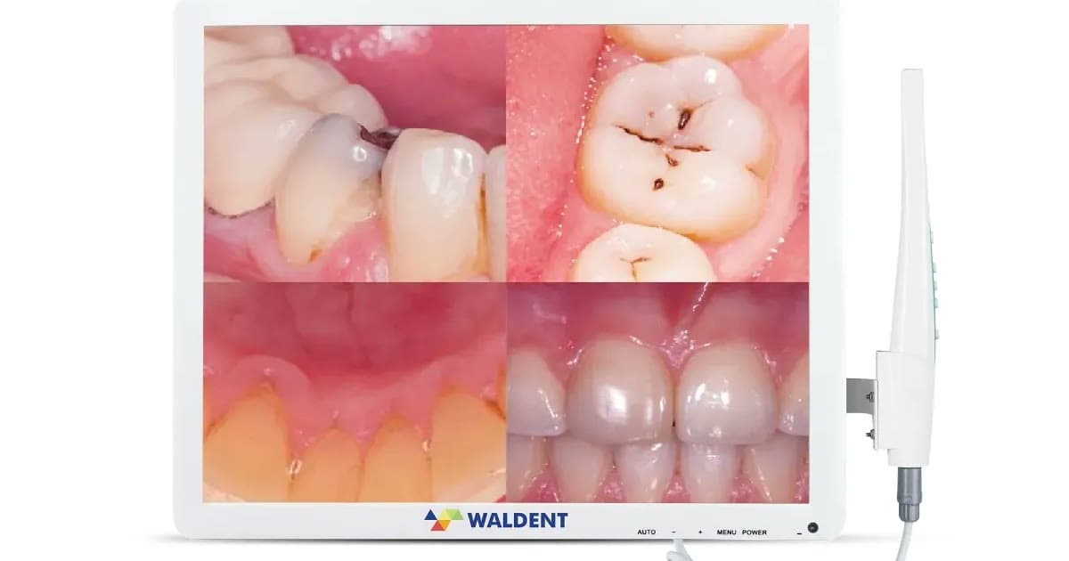 Tooth-Coloured Fillings vs Silver Fillings