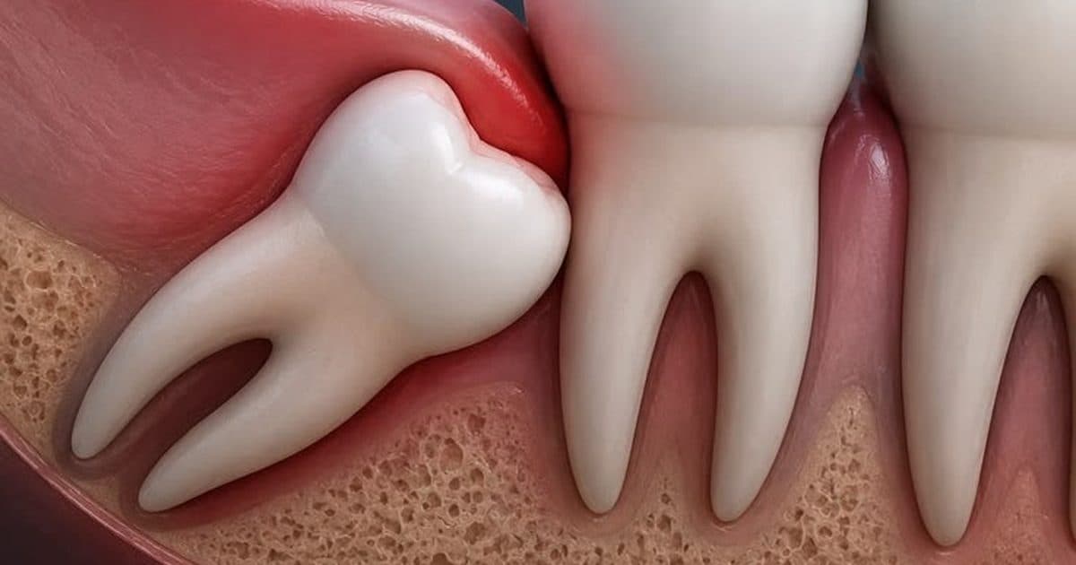 What to Eat After a Tooth Extraction