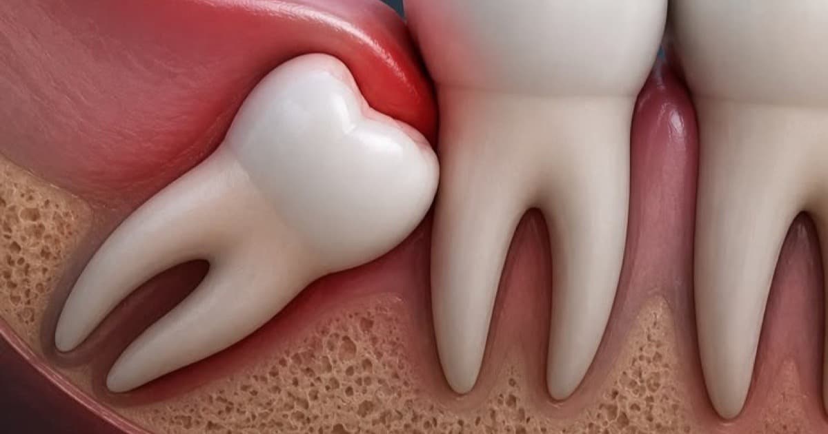 Wisdom Tooth Pain: When Is Removal Needed?